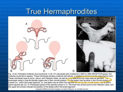 pregnant hermaphrodite|Pregnancy in a true hermaphrodite with a remaining ovotestis.